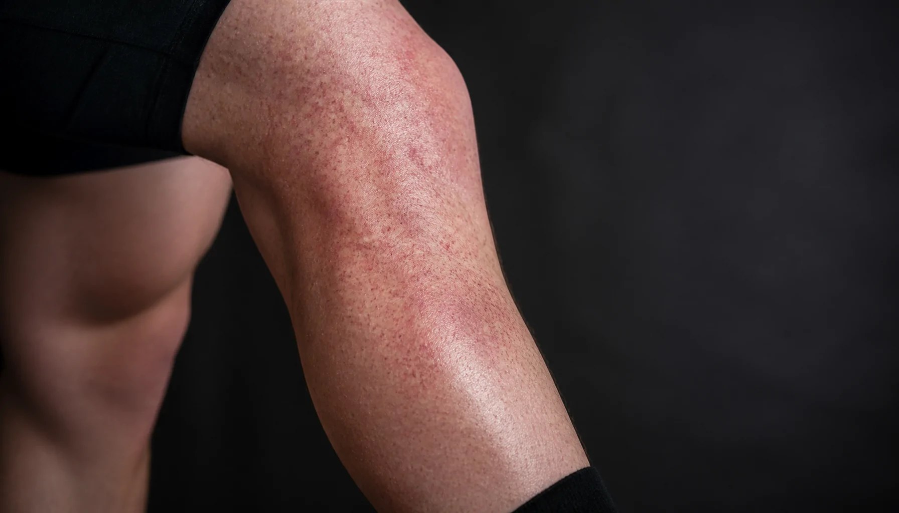 Taches rouges sur les jambes d'un coureur après un effort