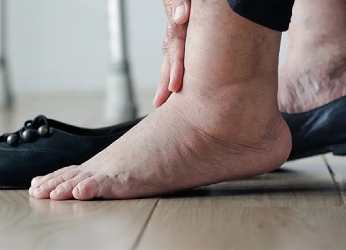 Cheville et pied gonflés en fin de journée, œdème visible sur le dessus du pied